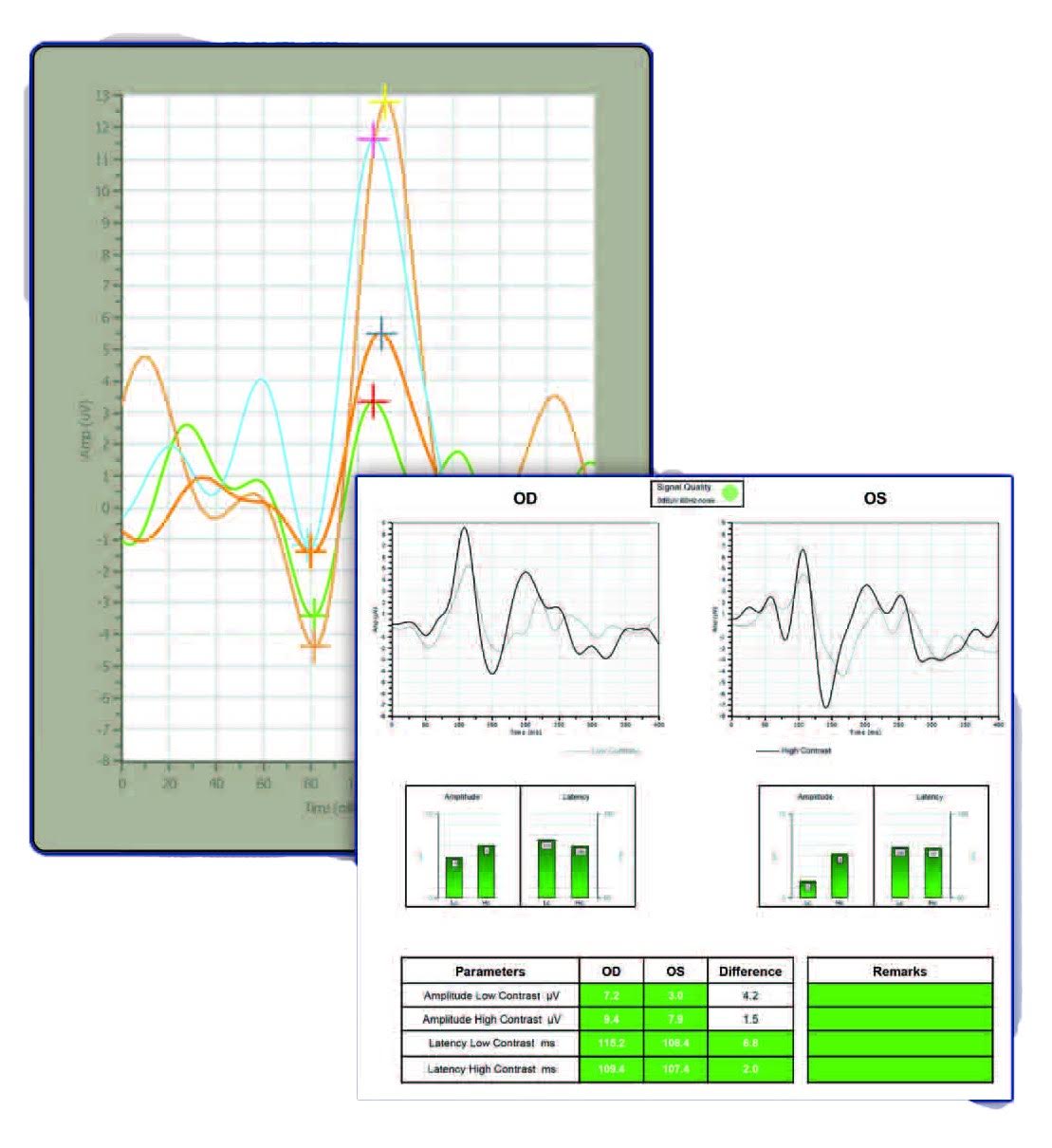 Diopsys® ERG vision test