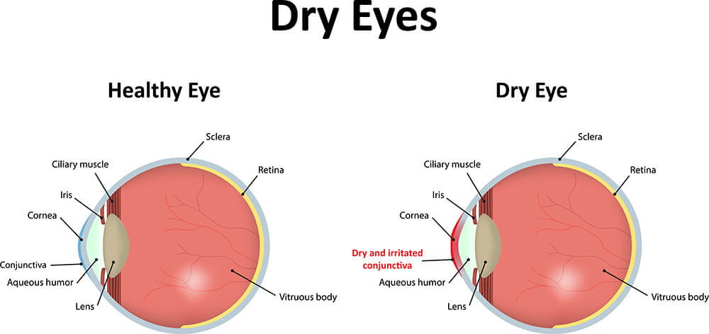 Dry Eye Diagram 