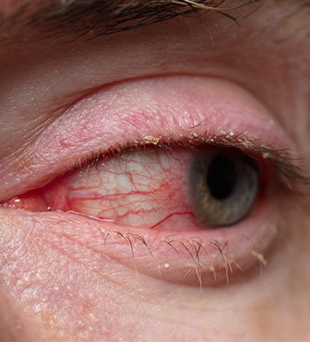 Blepharitis (bacterial infection of the eyelid edges)