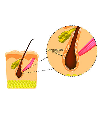 Demodex (skin mites infesting the eyelashes)