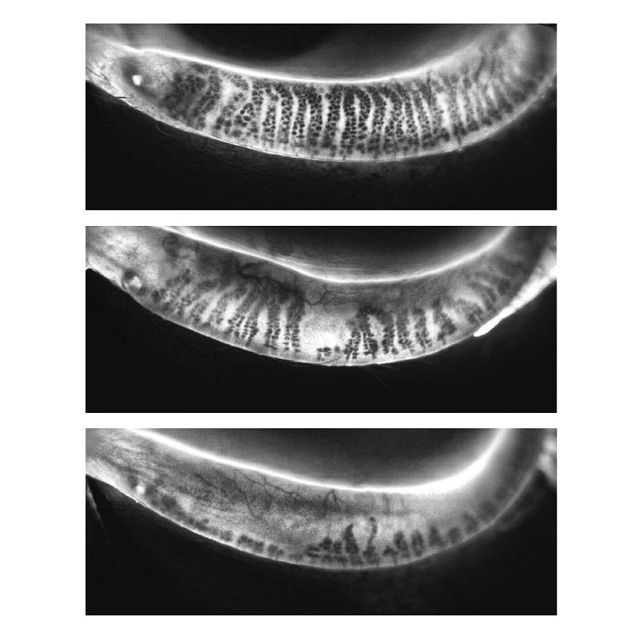 Image of the eyelid meibomian glands