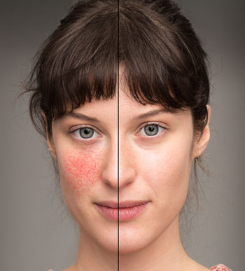 Rosacea (ocular rosacea) Rosacea